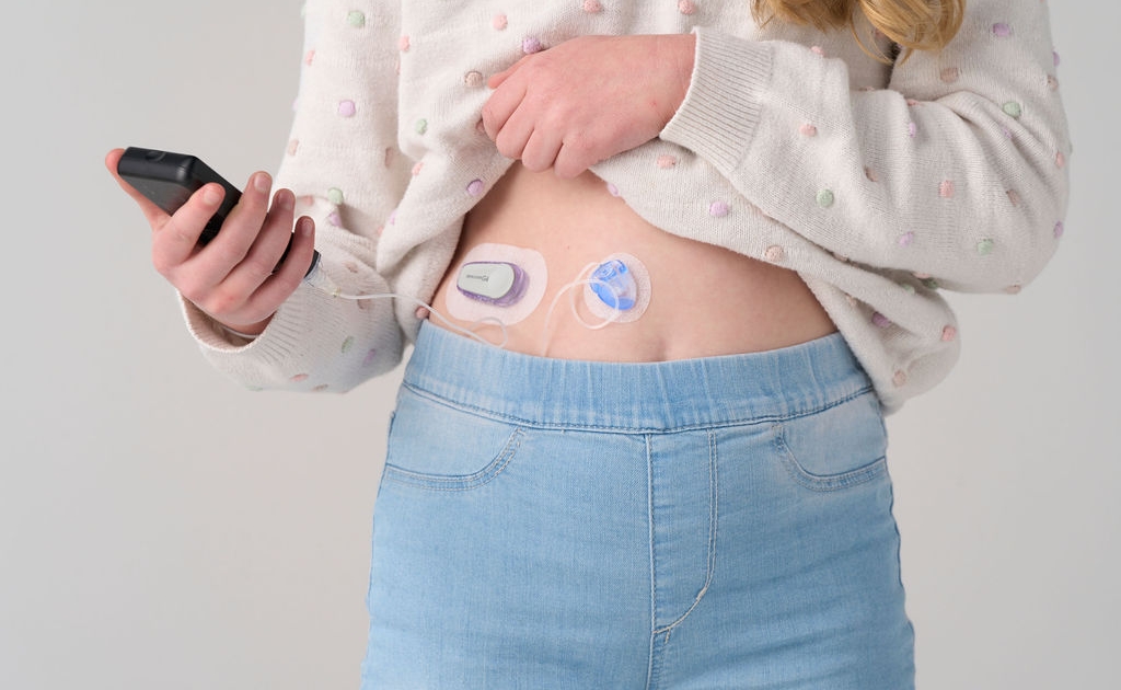 The Pediatric iLet is an automated insulin delivery system